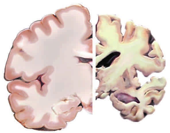 cervello sano confrontato con uno con malattia di Alzheimer